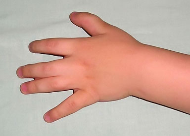 Синдактилия - полное или неполное сращивание пальцев, самый распространенный вид