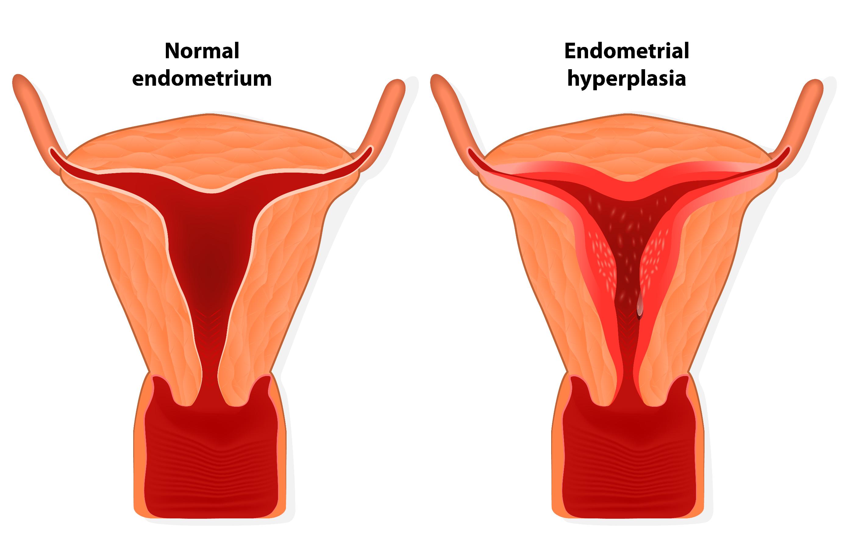 Гиперплазия эндометрия матки